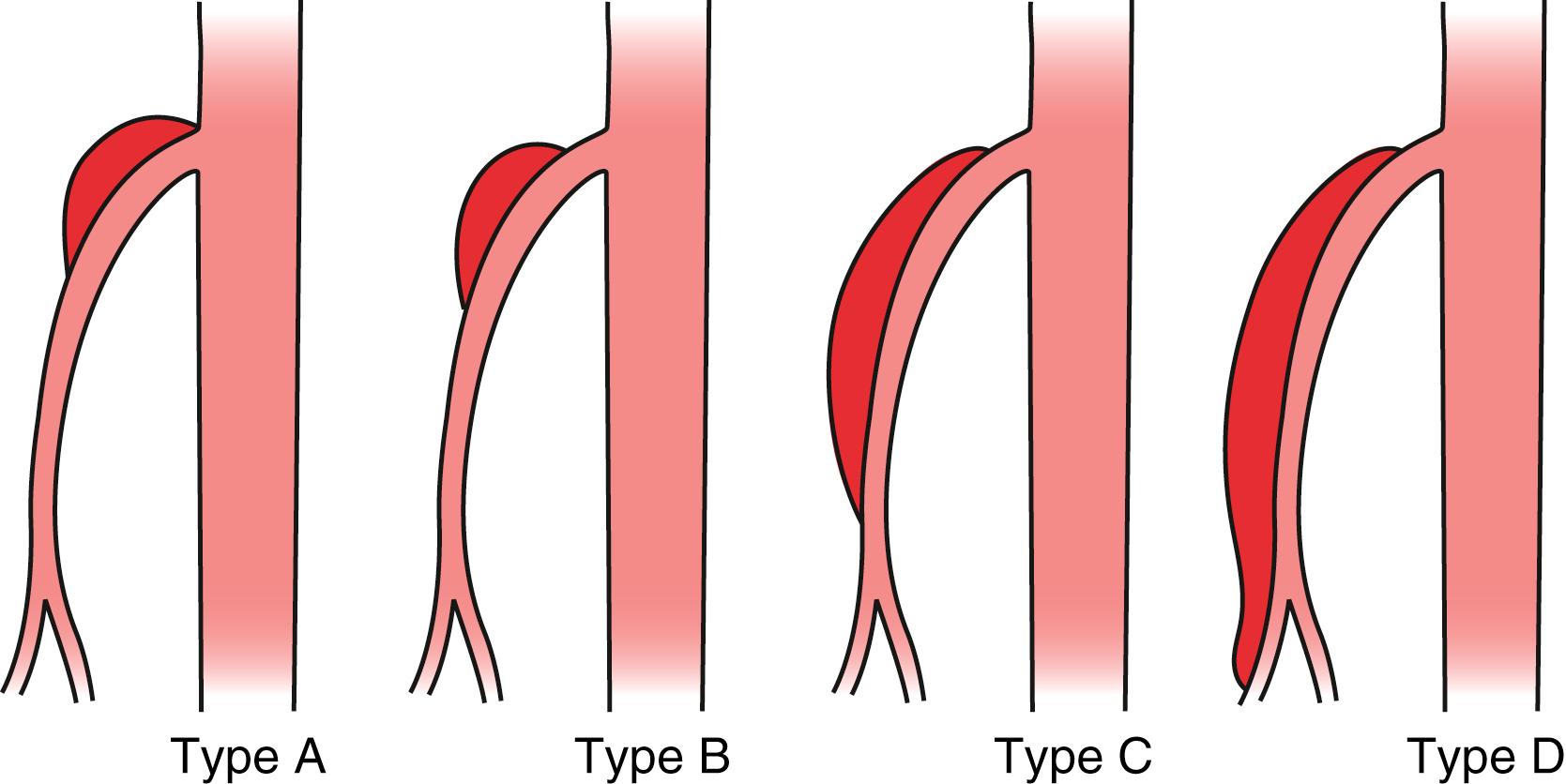 Figure 135.3, Classification system by Laun et al.: Type A dissection at the curve of the superior mesenteric artery (SMA) and extending proximally to the SMA ostium; Type B dissection limited to the curve of the SMA; Type C extending from the curve of the SMA distally, but not involving the ileocolic or distal ileal artery; Type D extending toward the ileocolic and/or ileal artery.