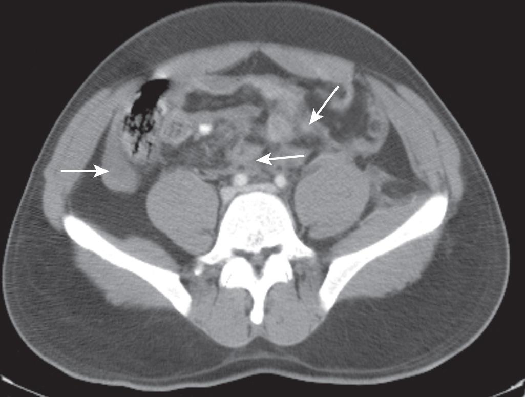 FIGURE 89.1, Mesenteric injury illustrated by associated free intraabdominal fluid (arrows) .