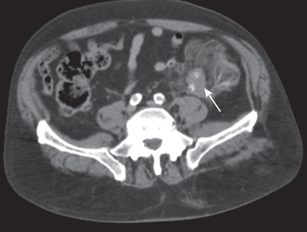 FIGURE 89.4, Mesenteric injury associated with active extravasation of contrast (arrow) . Also note the definition of the mesenteric vasculature by this injury.