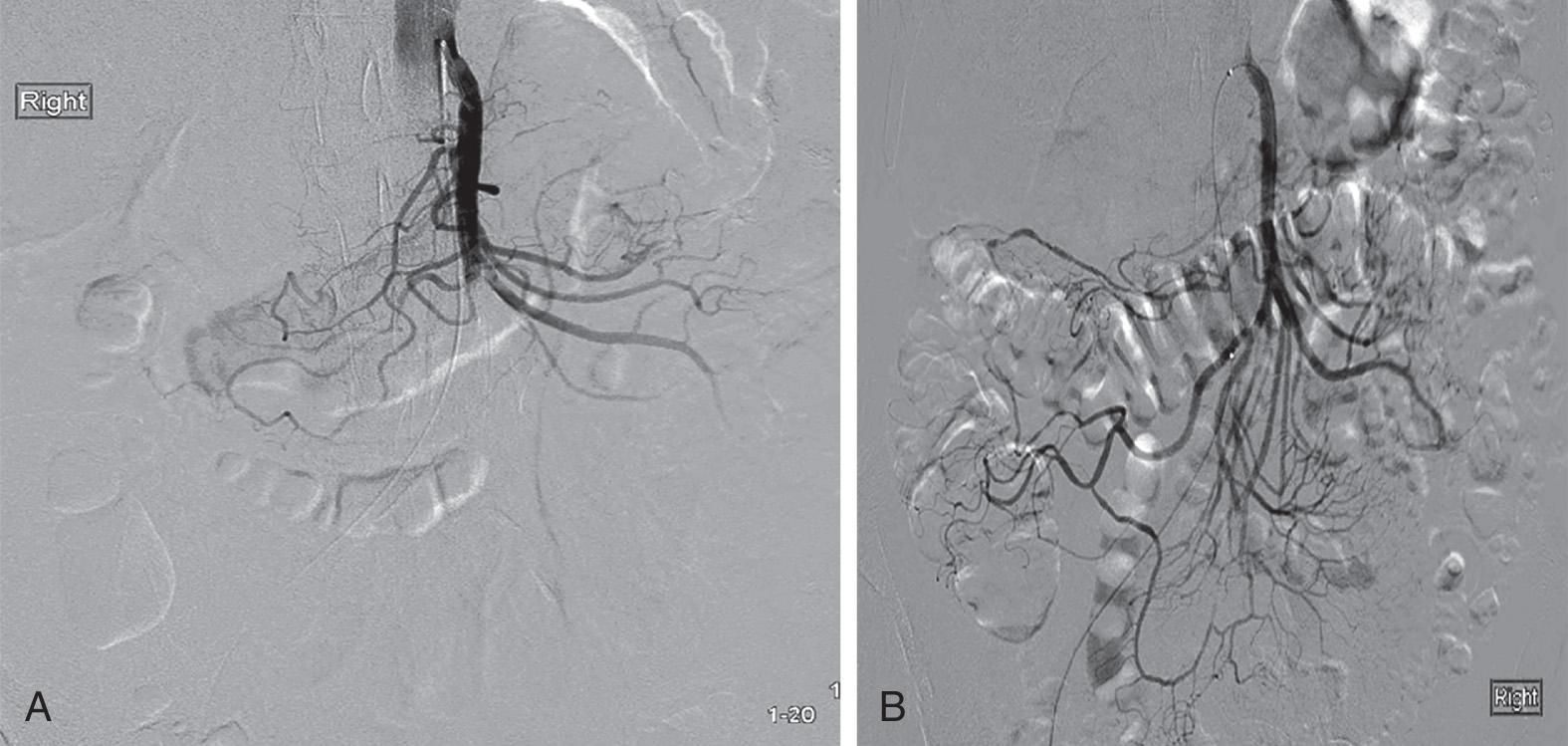 FIGURE 87.2, Computed tomography angiography showing superior mesenteric artery occlusion by embolus.