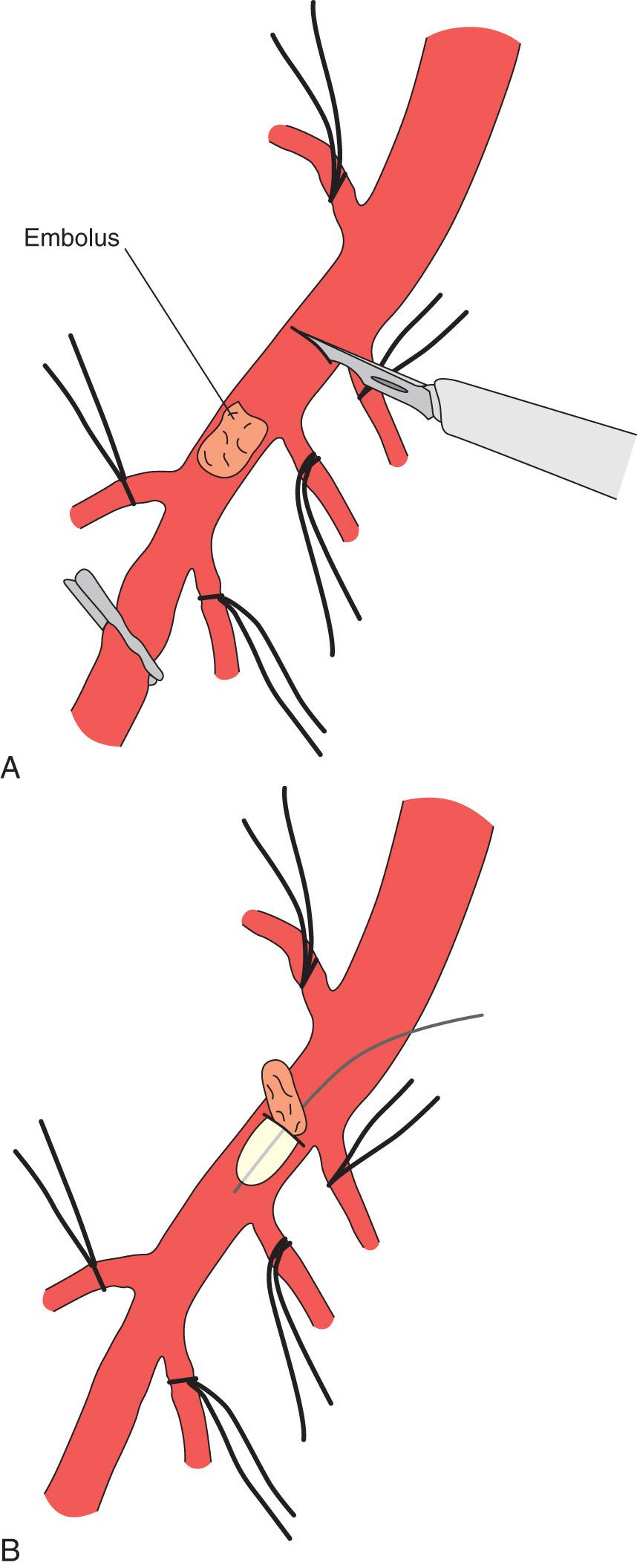 FIGURE 87.3, Embolectomy of superior mesenteric artery.