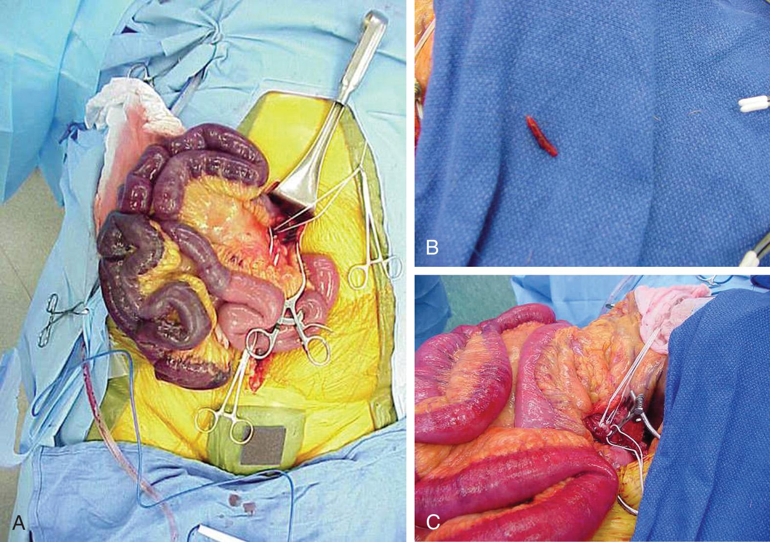 FIGURE 87.4, Ischemic segment of bowel caused by embolus to the superior mesenteric artery.