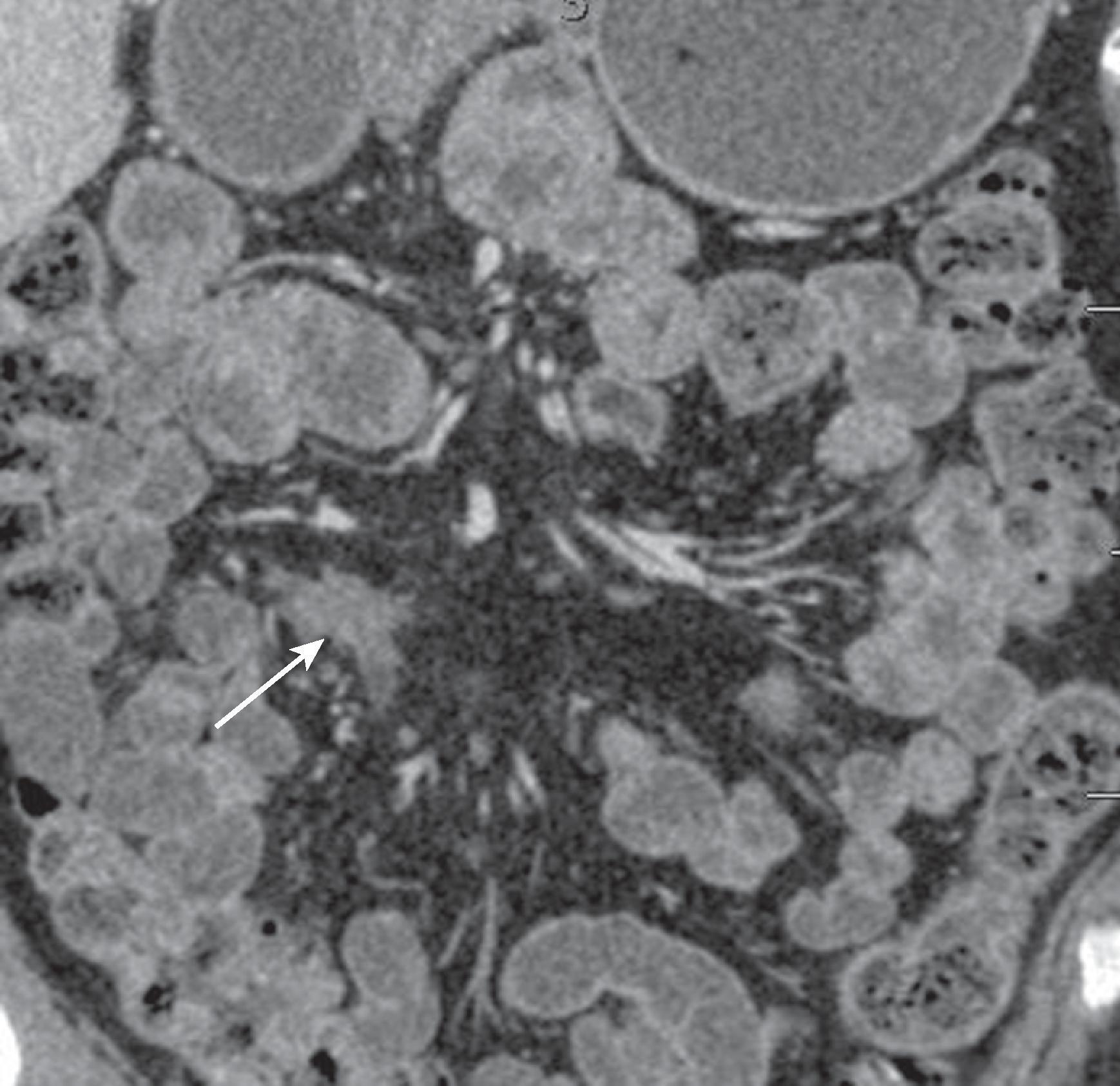 Fig. 66.1, Desmoid tumor.