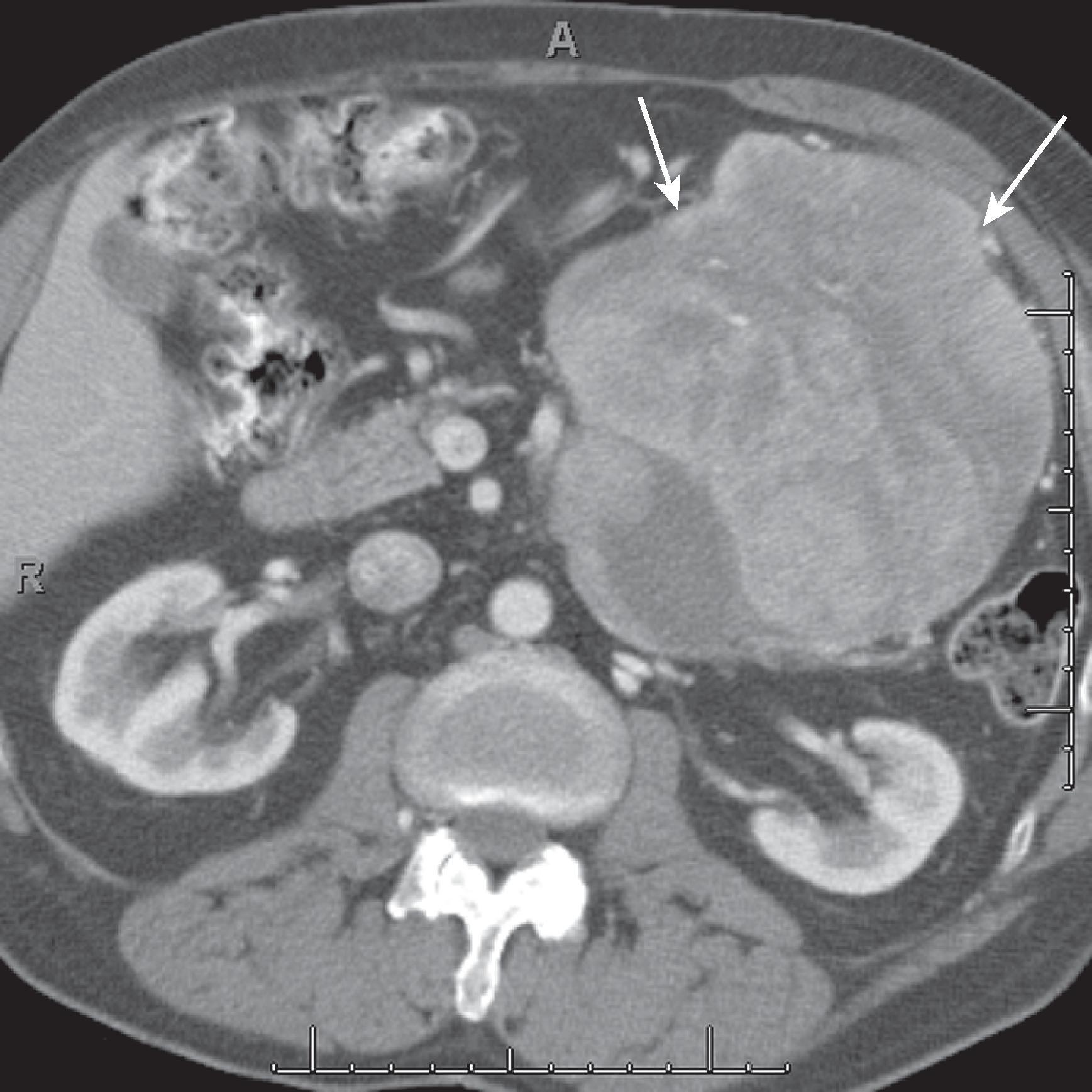 Fig. 66.11, Fibrosarcoma.