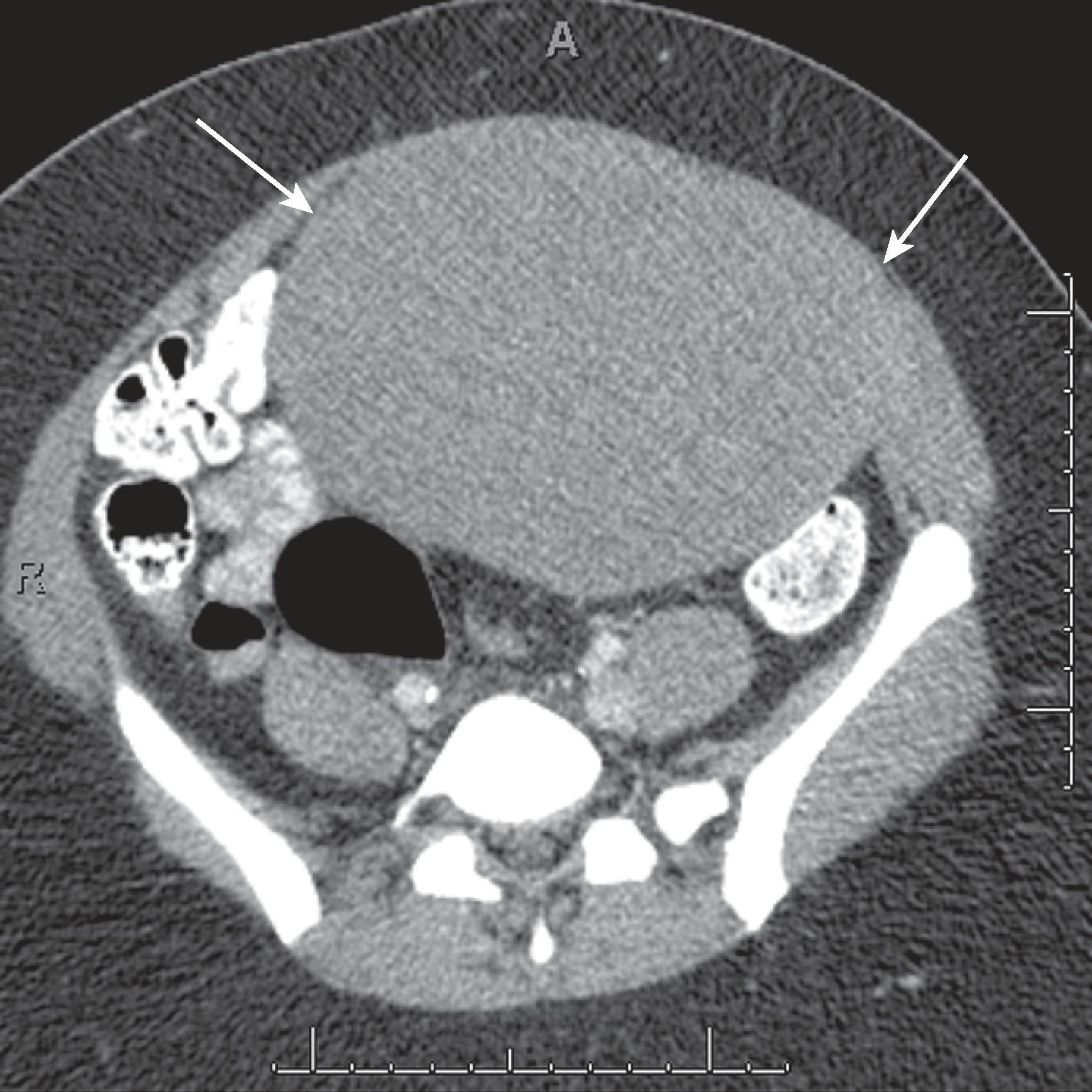 Fig. 66.2, Desmoid tumor.