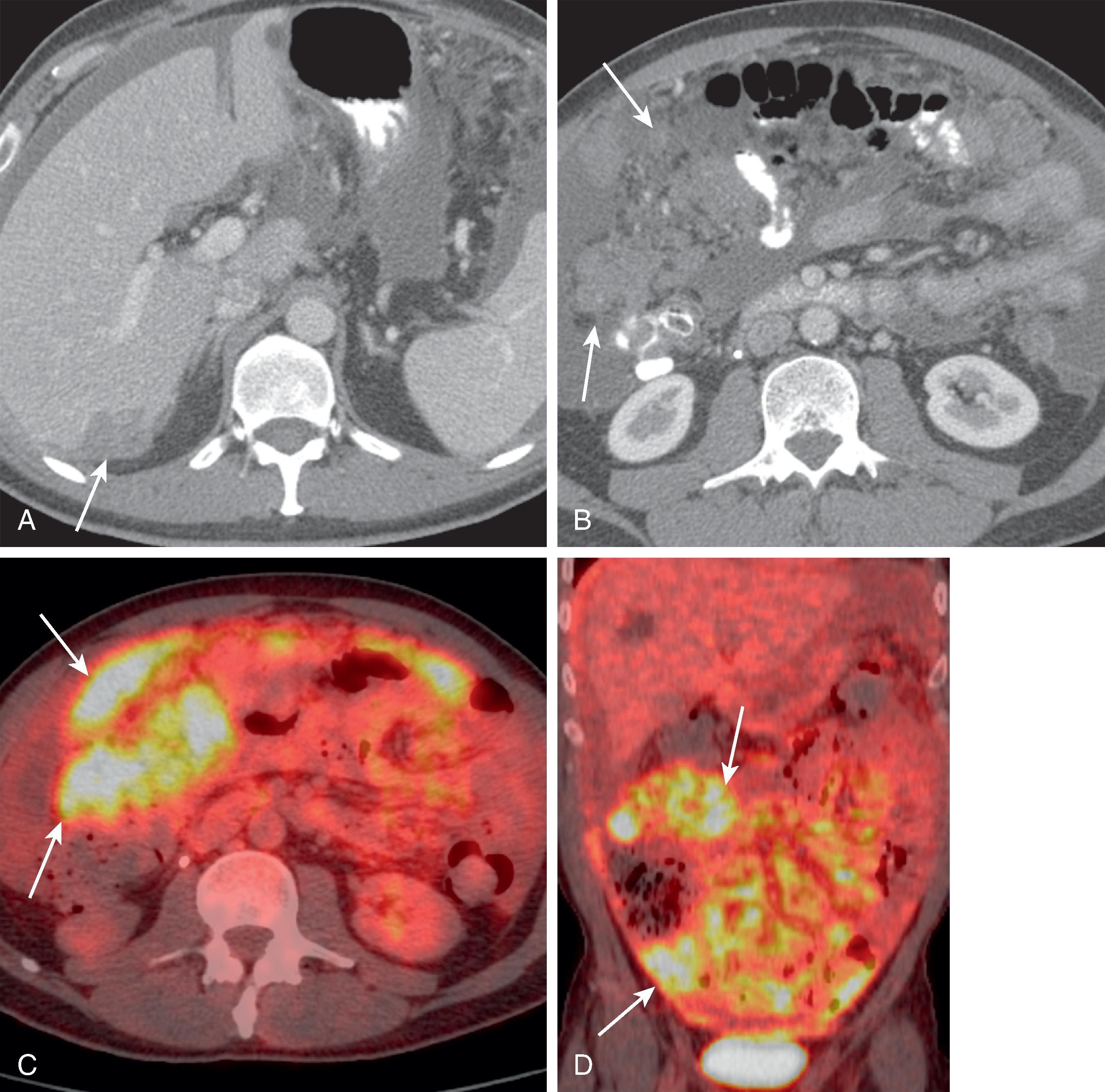 Fig. 66.4, Mesothelioma.