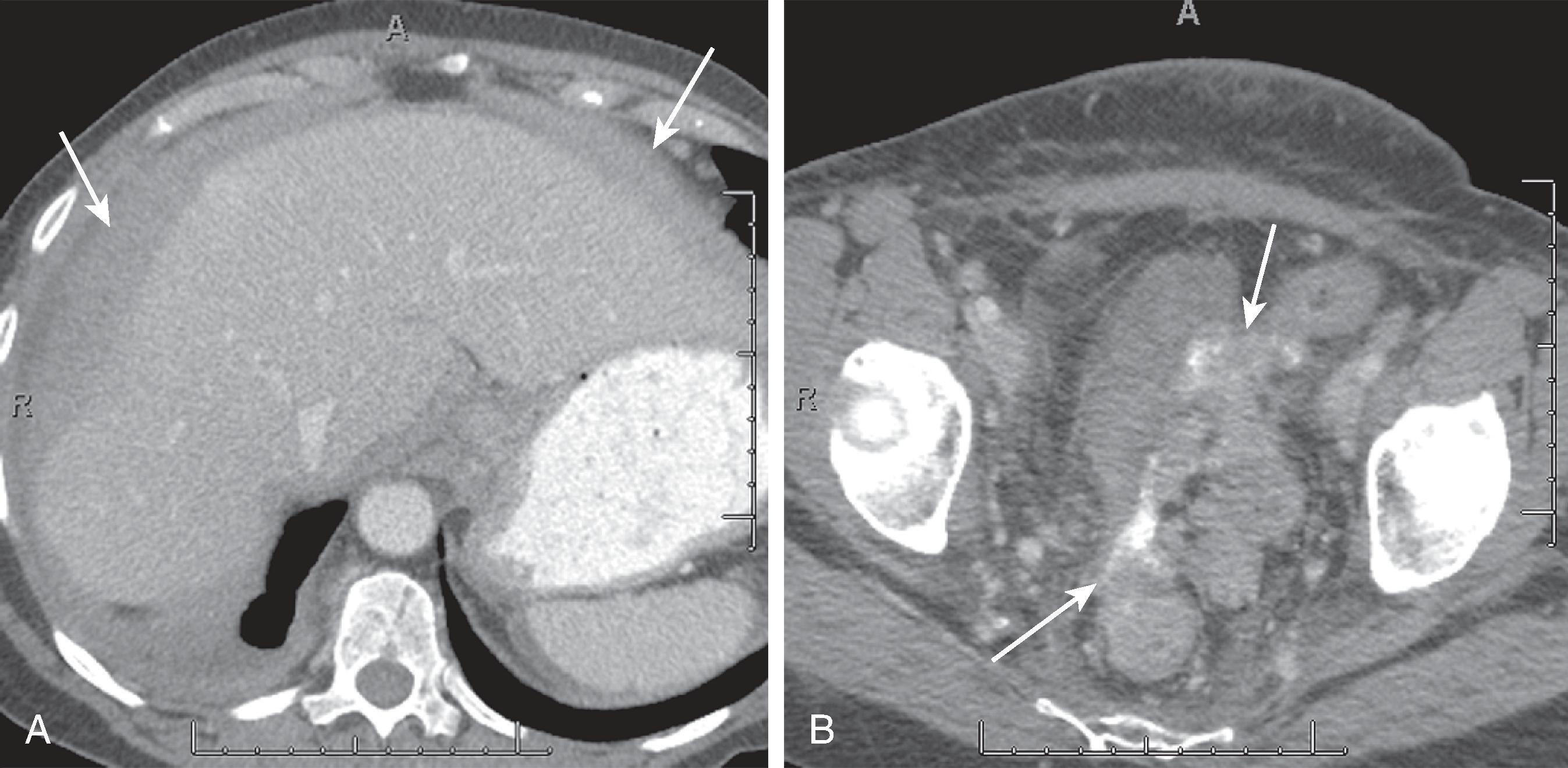 Fig. 66.5, Primary peritoneal papillary serous carcinoma.