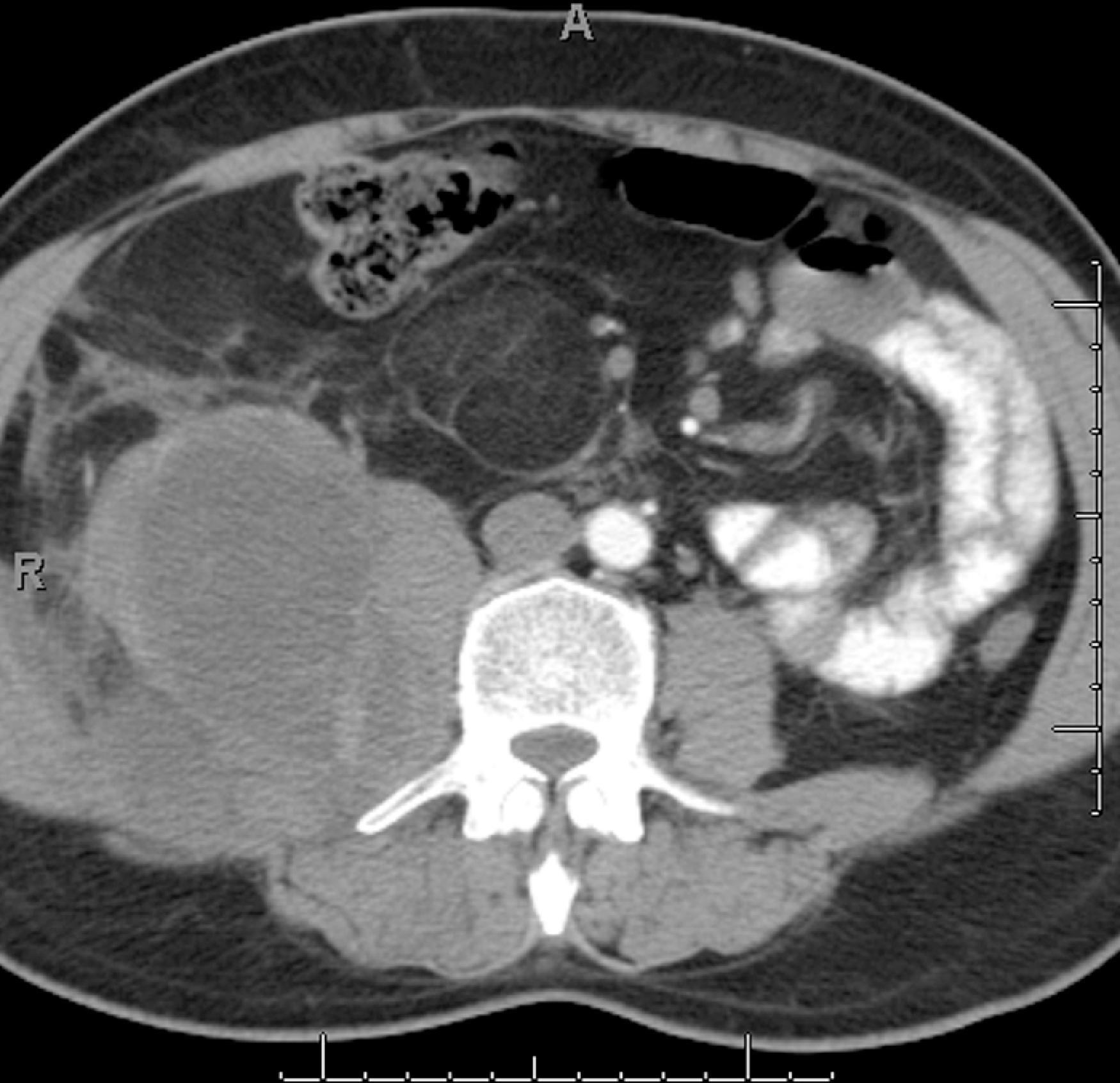 Fig. 66.7, Liposarcoma.