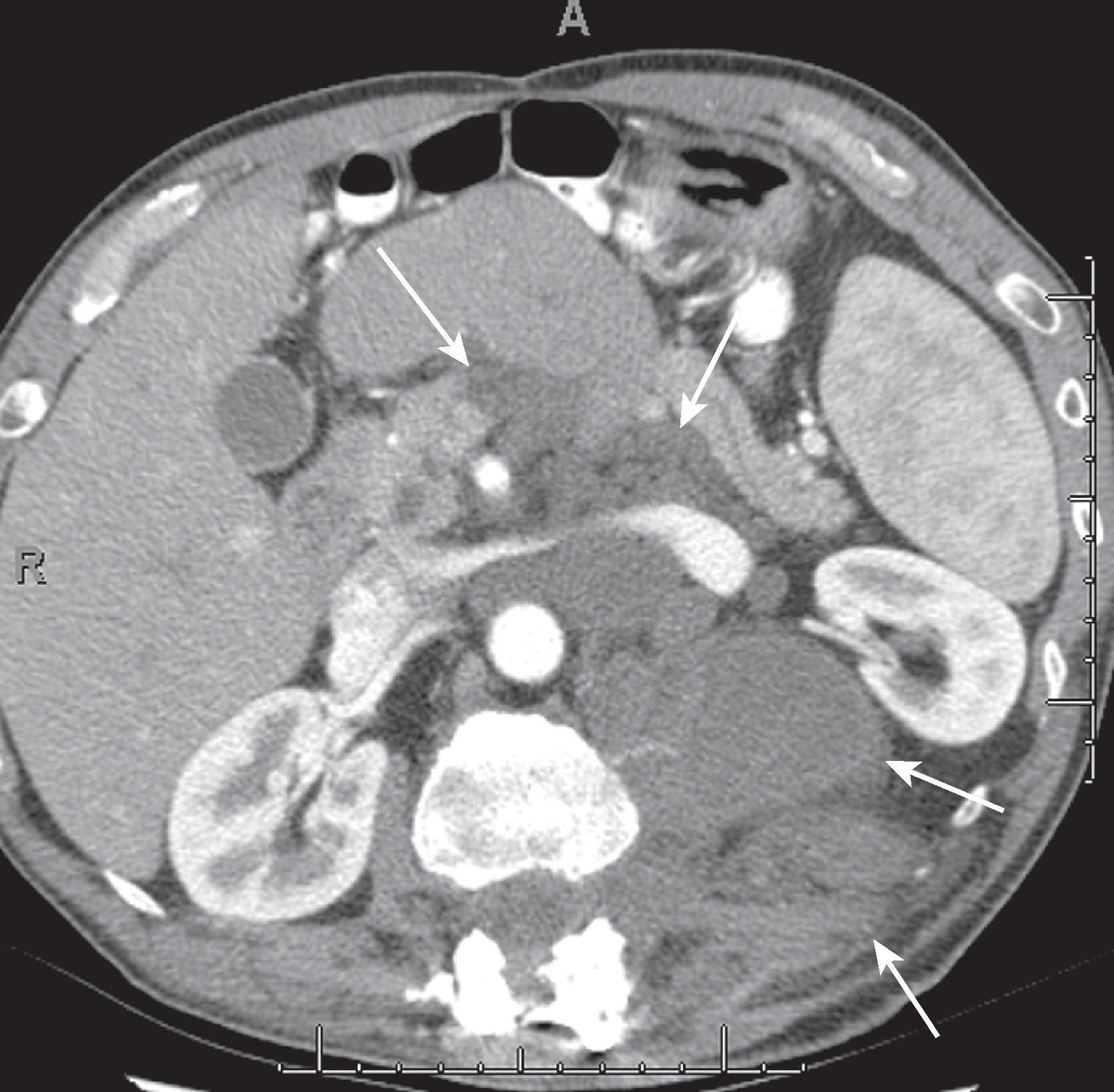 Fig. 66.10, Neurofibroma.