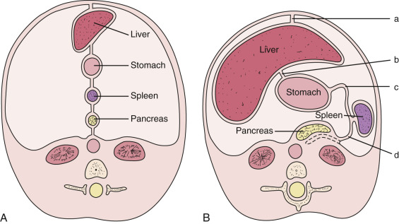 FIG 47-1, Schematic drawing of early fetal development of the mesentery. A, During the fourth week of embryonal life, cords of tissue from the ventral and dorsal mesogastrium grow rapidly, forming the liver and ventral pancreas within the ventral mesogastrium, while the spleen and the dorsal pancreas develop within the dorsal mesogastrium. The primitive foregut is suspended within the abdomen by the ventral and dorsal mesogastrium along with cords of tissue that divide the cavity into symmetric right and left halves. B, During early fetal life the dorsal margin of the stomach bulges rapidly along with rapid growth of the dorsal mesogastrium, forming a large greater omentum. Meanwhile the dorsal pancreas fuses to the posterior abdominal wall (dashed lines). a, falciform ligament; b, gastrohepatic ligament; c, gastrosplenic ligament; d, lienorenal ligament.