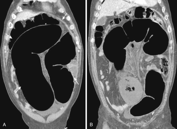 FIG 47-11, Sigmoid volvulus. A to D, Coronal reformatted CT shows distended sigmoid loop with inverted-U configuration and coffee bean sign (arrows). There is a whirlpool sign with torsion of the sigmoid vessels (arrowheads). A transition point with abrupt reduction in bowel caliber is seen.