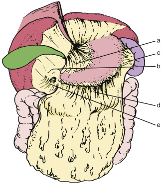 FIG 47-12, Schematic drawing of lesser omentum and greater omentum. Lesser omentum extends from lesser curvature of the stomach and superior border of the first portion of the duodenum to the liver into the fissure for the ligamentum venosum. Greater omentum drapes down from the greater curvature of the stomach and inferior border of the first portion of the duodenum, covering transverse colon and small bowel. Superior portion of the greater omentum extends to hilum of the spleen and becomes gastrosplenic ligament. a, gastrohepatic ligament; b, hepatoduodenal ligament; c, gastrosplenic ligament; d, gastrocolic ligament; e, duodenocolic ligament.
