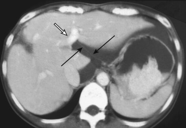 FIG 47-13, Lesser omentum. Axial CT shows the lesser omentum (black arrows) as a thin line in the fissure for the ligamentum venosum, extending from the lesser curvature of the stomach to the umbilical portion of the left portal vein (open arrow).