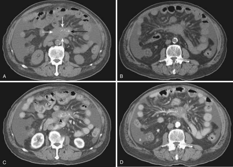 FIG 47-14, Sclerosing mesenteritis in a 70-year-old man. A and B, Noncontrast axial CT images show a well-circumscribed soft tissue mass (white arrows) in the small bowel mesentery, with coarse calcification (black arrow). C and D, On corresponding postcontrast images at the same level the mass encases the mesenteric vessels, causing vessel engorgement in the leaves of the mesentery and ascites (a). The superior mesenteric artery ( black arrowhead in C ) is encased by the soft tissue mass.