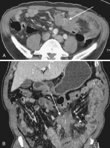 FIG 47-15, Inflammatory pseudotumor. Axial ( A ) and coronal ( B ) reformatted CT of the lower abdomen show spiculated soft tissue mass (arrows) in the mesentery. Mesenteric vessels ( arrowhead in B ) are encased and tethered, resulting in engorgement of vessels and thickening of the jejunal wall.