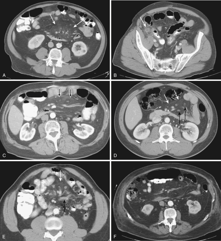 FIG 47-16, Mimics of mesenteric panniculitis. A and B, Axial postcontrast CT images show hazy infiltration of the small bowel mesentery (white arrows) due to appendicitis ( white arrow in B ). C, A band of soft tissue—the tumoral pseudocapsule (black arrows) —demarcating a “misty mesentery” in a patient with Crohn's disease. D, A hazy central small bowel mesentery (white arrows) with prominent lymph nodes (black arrows) in a patient who had been treated for testicular cancer. E, Misty mesentery (white arrow) with mesenteric vein engorgement (black arrow) in a patient previously treated for lymphoma. F, Hazy mesentery in a patient with pancreatitis. Fat ring sign ( C to F ) is well seen around vessels and lymph nodes.