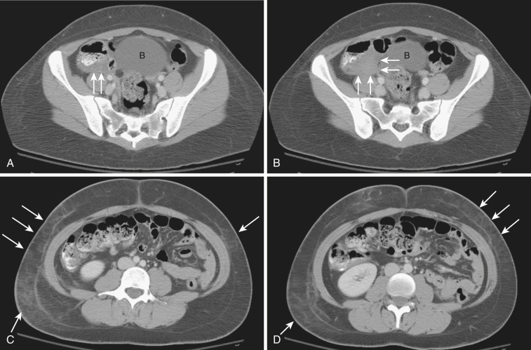 FIG 47-17, Seatbelt injury. A and B, Axial CT images demonstrate a bowel wall and mesocolic hematoma in the cecum (white arrows) in a patient following blunt abdominal trauma sustained from a motor vehicle accident. The patient was wearing a seatbelt at the time of impact. B, urinary bladder. C and D, Images more superiorly show bruising in the abdominal wall in the right lower and left upper quadrants (white arrows) in the distribution of the seatbelt.