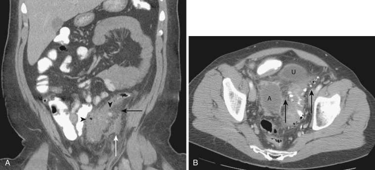 FIG 47-18, Sigmoid diverticulitis in two patients. A, Coronal reformatted CT shows abundant inflammatory changes (black arrow) surrounding the sigmoid colon, which has multiple diverticula (arrowheads) and a small fluid collection within the sigmoid mesentery (white arrow). B, Axial CT in another patient with sigmoid diverticulitis demonstrating soft tissue stranding in the mesenteric fat adjacent to diverticula (black arrows). There is a large associated abscess (A). Urinary bladder is displaced anteriorly (U).