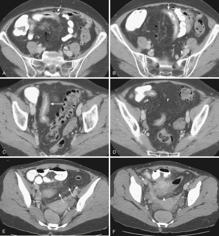 FIG 47-19, Active inflammatory bowel disease in two different patients. A to D, Serial axial CT images from a patient with Crohn's disease show a focal segment of thickened distal and terminal ileum (white arrows). Prominence of the vasa recta ( black arrowheads in B ) indicates active inflammation. Soft tissue inflammatory changes are also evident in the RLQ mesentery ( curved black arrow in A ). There is abundant fatty proliferation of the mesenteric fat in the small bowel and sigmoid colon (F). E and F, CT images from another patient with active Crohn's colitis show inflammatory changes in the fibrofatty proliferation of the sigmoid mesocolon (white arrows). Wall thickening and phlegmonous changes of the sigmoid colon are also present ( arrowhead in F ).