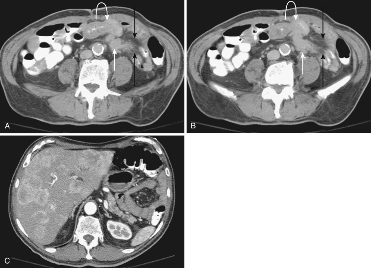 FIG 47-20, Small bowel carcinoid metastatic to mesentery and liver. A and B, Contrast-enhanced CT of the lower abdomen demonstrates a spiculated soft tissue mass in the mesentery (white arrows) with a “spoke-wheel” arrangement of the mesenteric vessels (black arrows). Adjacent small bowel thickening (curved arrows) represents bowel ischemia. C, CT image through the liver shows the typical enhancing metastatic lesions to the liver.