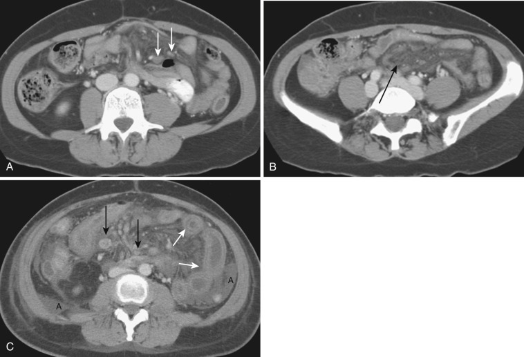 FIG 47-21, Thrombosis of branches of the SMV in two different patients. A and B, Axial CT images in the lower abdomen, showing more distal thrombus (white arrows) in branches of the SMV, with resultant mesenteric haziness, reflecting edema ( black arrow in B ). C, A different patient with thrombus in small tributaries of the SMV (black arrows), marked bowel wall edema (white arrows), and ascites (A).