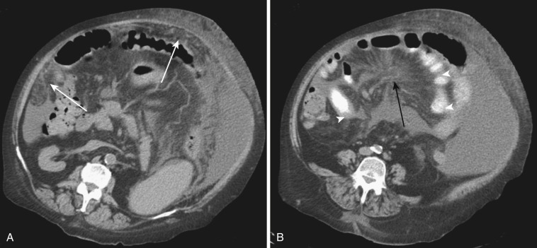 FIG 47-22, Liver cirrhosis with mesenteric edema and omental collateral. A, Nonenhanced CT at the mid abdomen shows omental collaterals (white arrows) mimicking mild omental caking. B, Lower-level CT slice shows hazy ill-defined mesenteric edema (black arrow). Note that engorged mesenteric vessels appear radiating. Small bowel wall is also thickened (arrowhead).