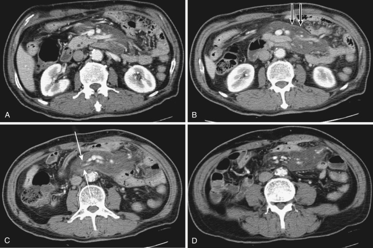 FIG 47-23, Mesenteric panniculitis in a 70-year-old man. A to D, Serial axial CT images show segmental increased attenuation in the small bowel mesentery, separated from the adjacent fat by a tumoral pseudocapsule ( black arrows in B ). There is preservation of the fat around vessels (fat ring sign) that are surrounded by the increased density ( white arrows in C )