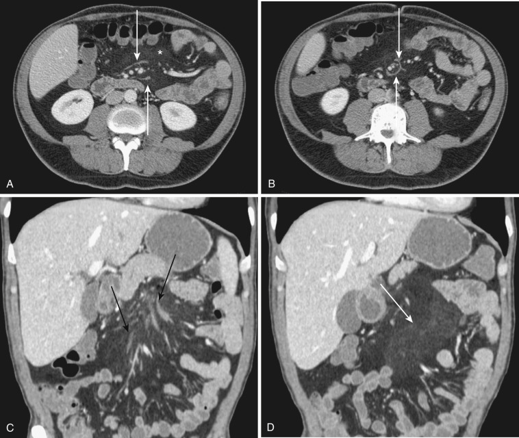 FIG 47-24, Idiopathic “misty mesentery.” A and B, Serial contrast-enhanced axial CT images show mild increased attenuation in the small bowel mesenteric fat (white asterisk). Additional linear branching soft tissue structures are within the mesentery, which are not identifiable as veins or arteries. These soft tissue structures are better appreciated on a coronal reformatted CT image ( C ) and presumably represent dilated lymphatics. D, A more anterior coronal reformatted CT image, redemonstrates the “misty mesentery” (arrow).