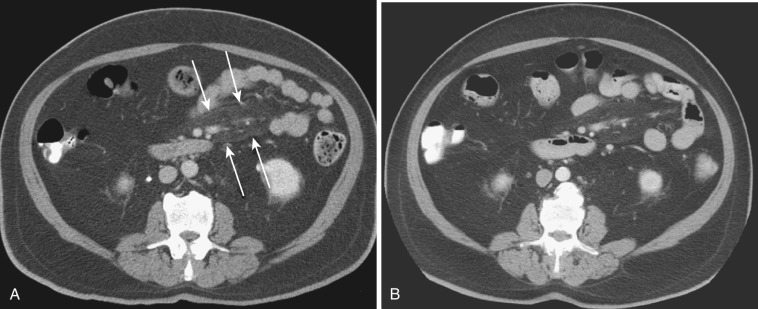 FIG 47-25, Idiopathic “misty mesentery” in a patient with chronic abdominal pain. A, Axial enhanced CT image shows increased attenuation in the small bowel mesentery, with a tumoral pseudocapsule (arrows). B, Findings were relatively stable after 2 years.
