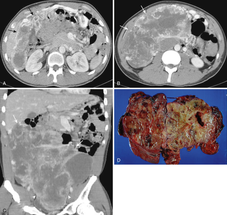 FIG 47-26, Omental GIST. Axial CT ( A and B ) and coronal reformatted CT ( C ) show a heterogeneously enhancing mass in the greater omentum (arrows). This mass extends to the pelvic cavity (arrowheads). D, Cut section of specimen shows large mass with hemorrhagic necrosis.