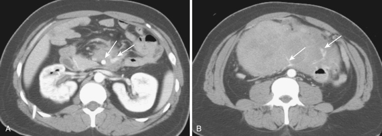 FIG 47-27, Mesenteric fibromatosis. A and B, Axial CT at two different levels of the abdomen show a soft tissue mass in the mesentery encasing mesenteric vessels (arrows) in a patient with total colectomy for Gardner's syndrome.