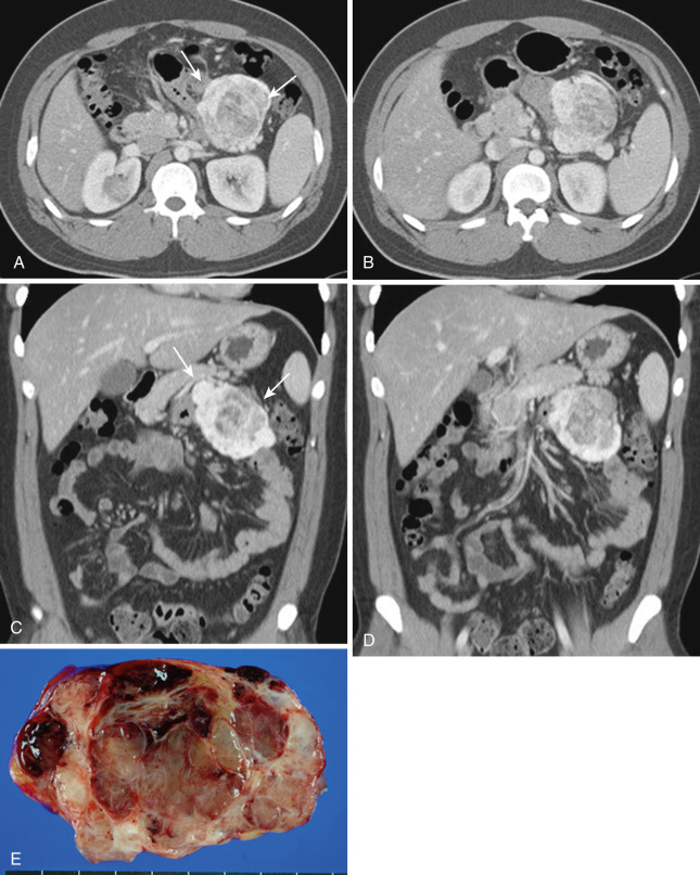 FIG 47-28, Solitary fibrous tumor arising in the mesentery. Axial CT ( A and B ) and coronal reformatted CT ( C and D ) show a well-defined hypervascular mass in the mesentery (arrows). E, Cut section of specimen shows well-defined yellow to white mass with hemorrhagic necrosis.