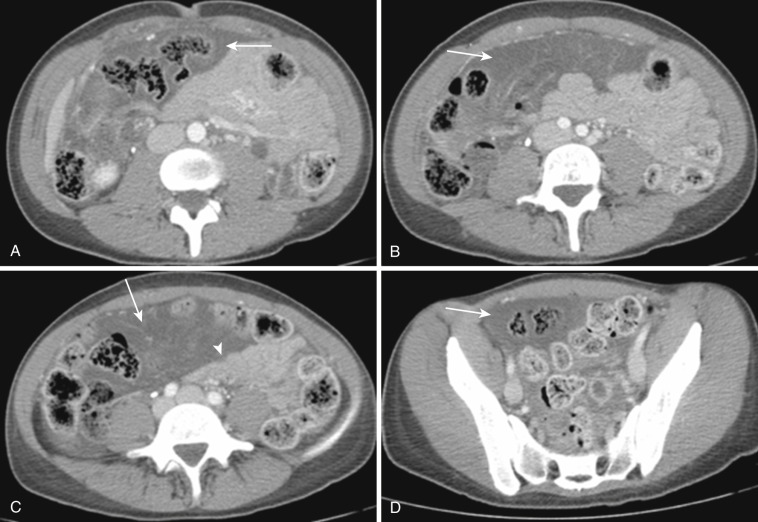 FIG 47-29, Cystic lymphangioma in transverse mesocolon. A to D, Axial CT at multiple levels through the abdomen and pelvis show a low-density mass lesion in the transverse mesocolon (arrows). Transverse colon appears to be floating in the mass. Minimal mass effect on adjacent small bowel loops is seen (arrowhead).