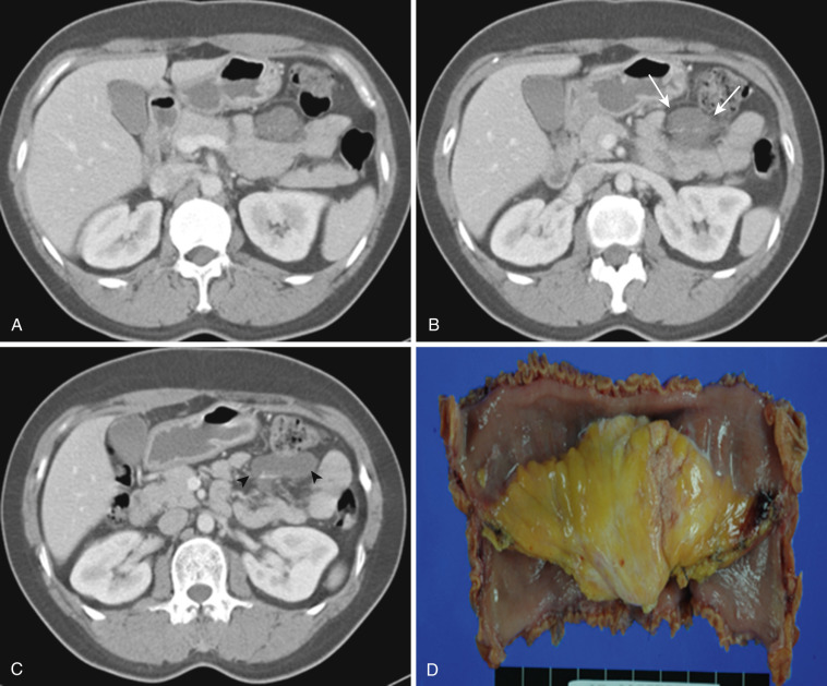 FIG 47-30, Cystic lymphangioma in mesentery. A to C, Axial CT at multiple levels show low-density mass lesion in the mesentery (arrows). Minimal mass effect on adjacent small bowel loops is seen (arrowhead). D, Surgical specimen shows well-defined yellow mass in the mesentery.