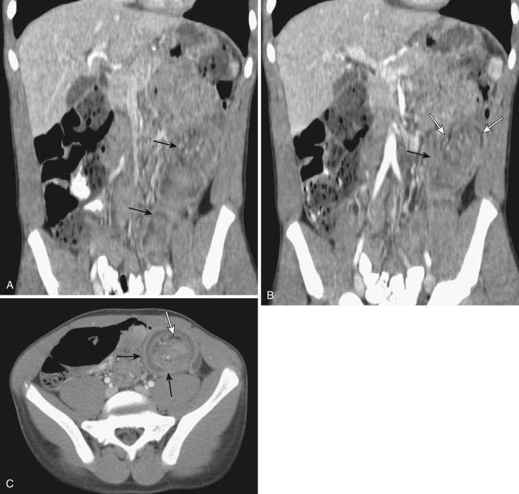 FIG 47-3, Colocolic intussusception of descending colon. Two consecutive coronal reformatted CT images ( A and B ) and one axial CT image ( C ) show a bowel-within-bowel appearance (black arrows) in the descending colon. Descending mesocolon is seen as a curvilinear fat density (white arrow) as part of the intussusceptum.