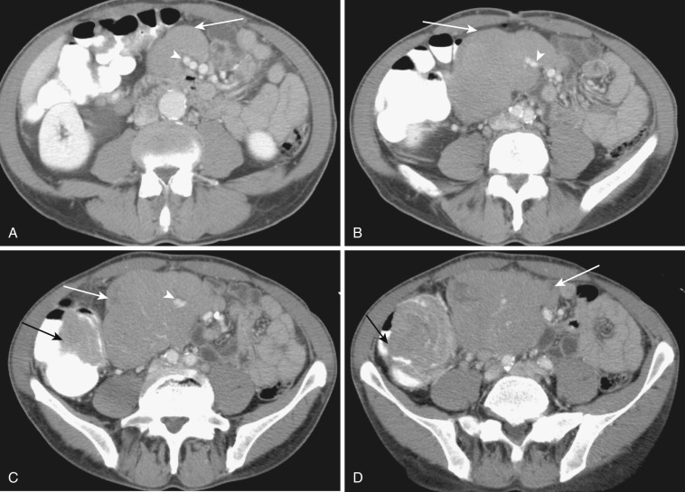 FIG 47-31, Lymphoma. A to D, Four consecutive axial CTs of the abdomen and pelvis show conglomerate mesenteric lymph nodes (arrows). Mesenteric vessels (arrowheads) are surrounded and engulfed by the mass but not encased, distorted, or narrowed. Note a bulky mass in cecum (black arrows).