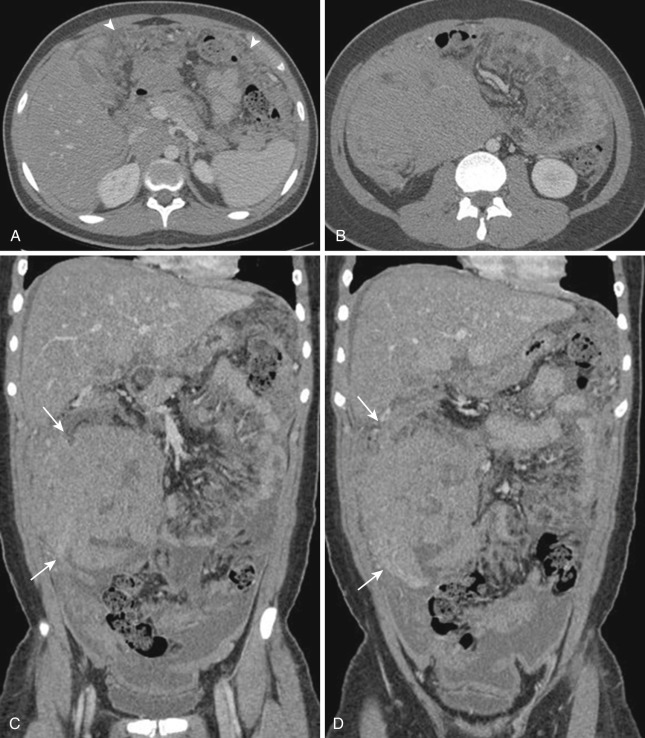 FIG 47-32, Lymphoma. Axial CT ( A and B ) and coronal reformatted CT ( C and D ) images of the abdomen and pelvis show omental caking (arrowheads) and a bulky masslike lymphoma implantation onto pleats of right side omentum (arrows).