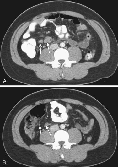 FIG 47-33, Ileocolic lymphadenopathy with appendicitis. A, Lower abdominal CT during acute appendicitis shows several enlarged lymph nodes (arrows) . B, Following antibiotic treatment these lymph nodes (arrows) dramatically decrease in size.