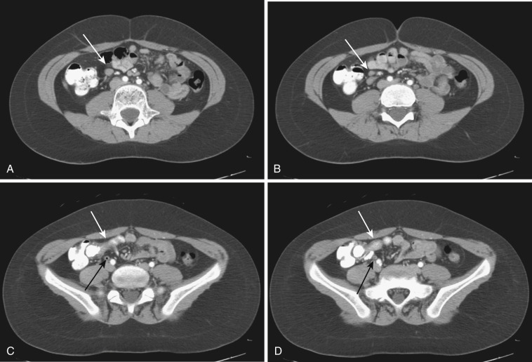 FIG 47-34, Mesenteric adenitis. A to D, Axial CT of the lower abdomen and pelvis shows multiple enlarged RLQ mesenteric lymph nodes (white arrows in A and B ) and mild thickening of the terminal ileum (white arrows in C and D ) in a pediatric patient presenting with RLQ pain. The appendix is normal (black arrows in C and D ).