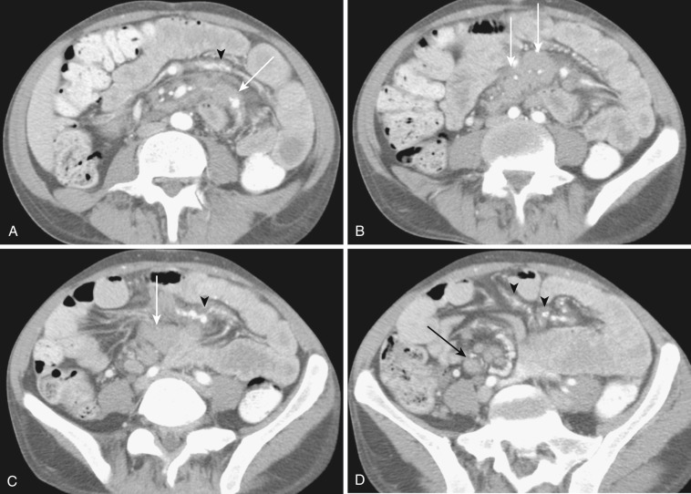 FIG 47-35, Mesenteric adenopathy in a 41-year-old man with HIV, AIDS, and Mycobacterium avium complex (MAC). A to D, Serial axial contrast-enhanced CTs show conglomerate adenopathy (white arrows) in the mesentery. More discrete enlarged nodes are in the RLQ (black arrow). Nodes are of homogenous soft tissue attenuation. Note vascular engorgement and perivascular edema (black arrowheads).