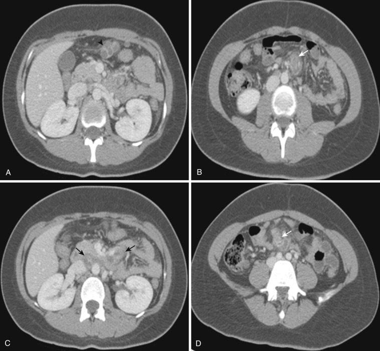 FIG 47-36, Tuberculous lymphadenopathy. A to D, Axial CT of the abdomen and pelvis shows multiple enlarged lymph nodes in the mesentery (arrows). A hypodense center is noted (arrowhead).