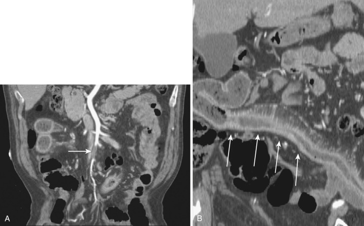 FIG 47-37, SMA embolus. A, Curved planar reformatted image of the SMA shows a filling defect (arrow) in a branch of the SMA consistent with an embolus in a patient with known atrial fibrillation. B, Another curved planar reformatted image shows abnormal enhancement and wall thickening in a long segment of ileum (arrows) related to ischemia.