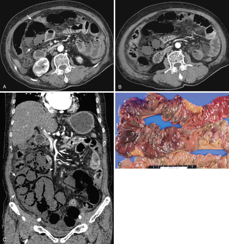 FIG 47-38, SMA thrombosis and ileal ischemia. Axial CT ( A and B ) and coronal reformatted CT ( C ) images of the abdomen and pelvis show a filling defect (arrowhead) in SMA consistent with a thrombosis. Small bowel loops show poor enhancement and air in the wall (arrows). Surgical specimen shows transmural ischemic necrosis in the involved small bowel.