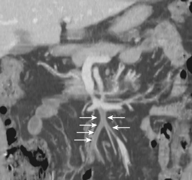 FIG 47-39, SMV thrombosis. Coronal reformatted image shows extensive occlusive thrombus (arrows) in the jejunal and ileal tributaries of the SMV in a patient who is hypercoagulable.