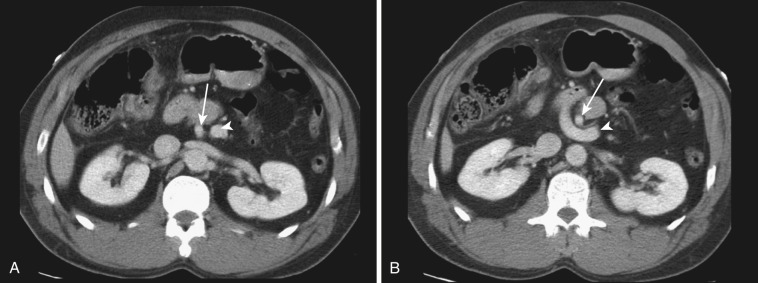 FIG 47-40, Malrotation of the intestine. A and B, Two consecutive axial CTs show reversal of the SMA (arrow) and SMV (arrowhead) position, with SMV being to the left of the SMA.