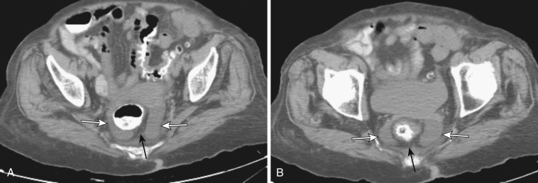 FIG 47-4, Peritonealized rectum by mesorectum. A and B, Two consecutive axial CTs of the pelvis show ascites in bilateral pararectal fossae (white arrows) that extends behind the rectum, demarcating the fat-containing mesorectum (black arrow).