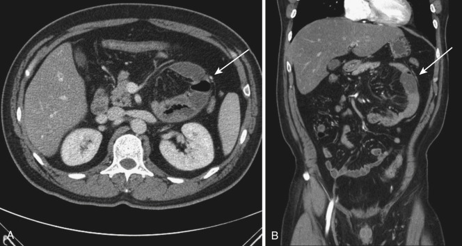 FIG 47-41, Left paraduodenal hernia. Axial ( A ) and coronal ( B ) CTs show contained clustered loops of small bowel in left upper abdomen. Note the anterior displacement of inferior mesenteric vein ( arrow).