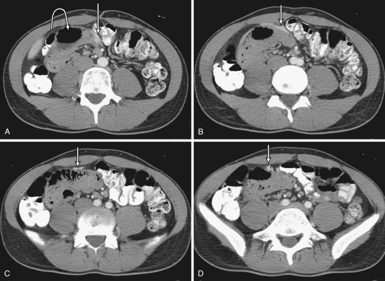 FIG 47-42, Right paraduodenal hernia in an asymptomatic patient. A to D, Serial contrast-enhanced axial CTs demonstrate mildly dilated small bowel loops herniating into Waldeyer's fossa (curved arrow). The right colic vein (straight white arrows) is displaced anteriorly by the herniated bowel loops.