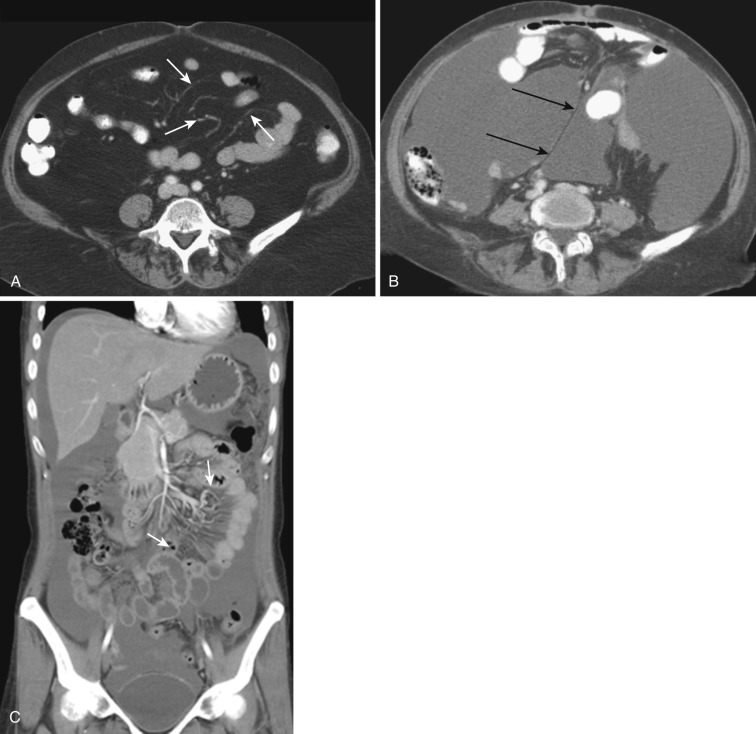 FIG 47-5, Small bowel mesentery in a normal subject ( A ) and a patient with ascites ( B and C ). A, Normally the mesentery is not identified as individual pleats. Mesenteric fat is inseparable from retroperitoneal and omental fat. It can be indirectly traced and identified by the undulating vessels (arrows). B and C, Once there is enough ascites, each pleat of mesentery can be separately identified. A long thin mesenteric attachment to the root of the mesentery ( arrows in B ) is well depicted. The mesentery can be easily traced and identified by the mesenteric vessels on coronal reformatted CT ( arrows in C ).