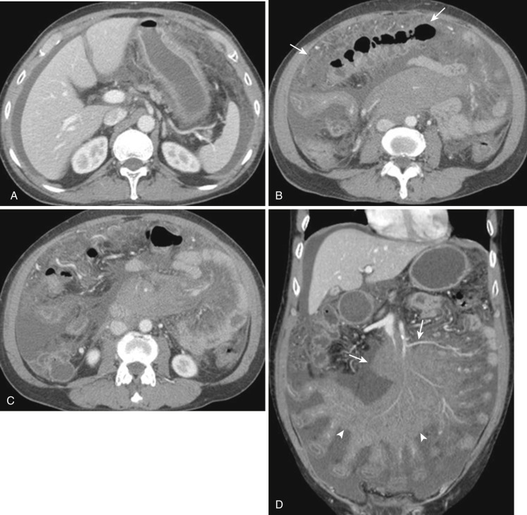FIG 47-6, Peritoneal lymphomatosis. A to C, Axial CT of abdomen and pelvis and ( D ) coronal reformatted CT show omental caking (arrow) and masslike lymphoma implantation onto pleats of mesentery ( arrowheads in D ). A long thick mesenteric attachment to the root of the mesentery ( arrows in D ) is well depicted.